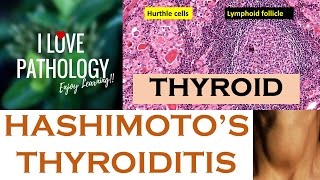 HASHIMOTOS THYROIDITIS Etiopathogenesis Morphology amp Complications [upl. by Ambros]