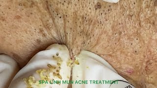 Acne treatment for 90yearold gentlemen part 1  Acne treatment under the skin 013 [upl. by Lincoln355]