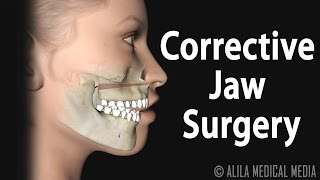 Basics of Osteotomy [upl. by Brig353]