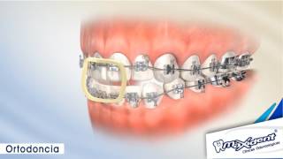 Corrección de mordida y espacios dentales quotOrtodonciaquot [upl. by Amilb701]