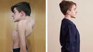 20 mins Posture Routine for Kyphosis Rounded Upper Spine [upl. by Blisse]