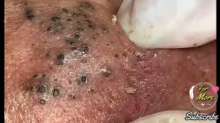 Dr Pop  Deep Blackheads in old Skin removing amp treatment 2020 Part 6 [upl. by Beauchamp]