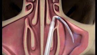 Intra Aortic Balloon Pump IABP  Timing and Mechanism [upl. by Viridissa]