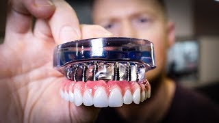 DENTURES vs Dental IMPLANTS Full Mouth Rehabilitation  See the Smile Transformation [upl. by Bierman]