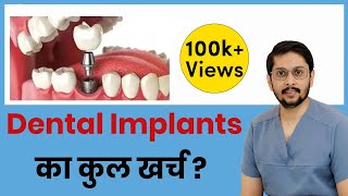 What is the cost of DENTAL IMPLANTS [upl. by Anikahs66]