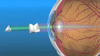 Multifocal Lens IOL [upl. by Eenyaj]