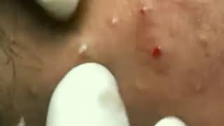 Severe Acne treatment [upl. by Ojadnama]