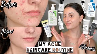 How I Cleared My HORMONAL ACNE amp SCARRING with Affordable Skincare  Dry amp Sensitive Skin [upl. by Giordano]