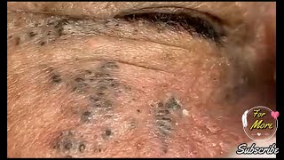 Dr Pop  Deep Blackheads in old Skin removing amp treatment 2020 Part 5 [upl. by Chuch]