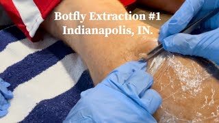 Botfly Extraction  55 day gestation  explosive extraction [upl. by Ettelloc]