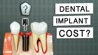 How Much Do Dental Implants Cost [upl. by Doralia]