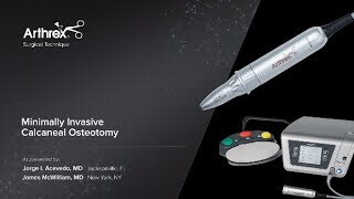 Minimally Invasive Distal Metatarsal Osteotomy [upl. by Laks]