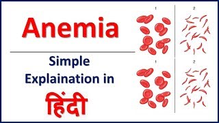 Anemia amp its types simple explaination in Hindi  Bhushan Science [upl. by Gilba182]