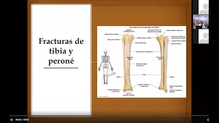 FRACTURA DE TIBÍA Y PERONÉ [upl. by Kreitman]