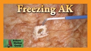 Freezing Hand Actinic Keratosis with Liquid Nitrogen  Auburn Medical Group [upl. by Aicined]