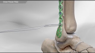 Distal Fibular Plate [upl. by Limaa]