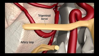 Retrocalcaneal Heel BURSITIS Treatment Heel Pain Exercises amp Massage [upl. by Sidnala]