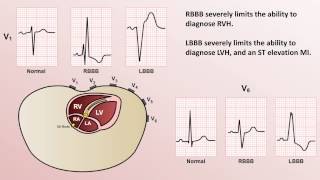 Intro to EKG Interpretation  Bundle Branch Blocks [upl. by Neitsirhc]