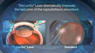 The Alcon LenSx Laser [upl. by Wayland]