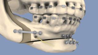 BSSO amp Osseous Genioplasty [upl. by Ahsinuq]