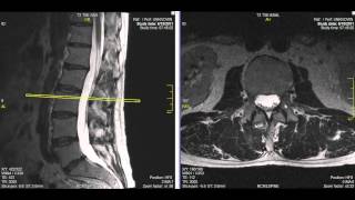 Normal Lumbar Spine MRI Explained  Dr Jeffrey P Johnson  HD [upl. by Eerahc]