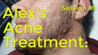 Alexs Acne Treatment Session1 [upl. by Nosnehpets]