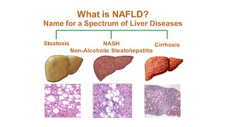 Fatty Liver Disease amp NASH Nonalcoholic Steatohepatitis  Causes Symptoms Diagnosis amp Treatment [upl. by Richara658]