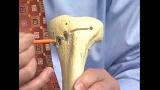 Osteoid Osteoma Bone Pathology Basics [upl. by Eiramalegna]