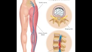 What is Sciatica [upl. by Spike]