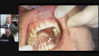 Dr Tom’s Tips – Placing Veneers With the New Isolite® Anterior Isolation System [upl. by Vevina]