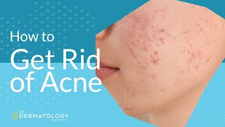 Acne Treatment  Explained by Dermatologist [upl. by Jeffry162]