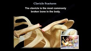 Clavicle Fractures  Everything You Need To Know  Dr Nabil Ebraheim [upl. by Adnilasor]