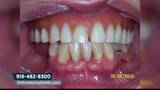 How Much are Mini Dental Implants [upl. by Niwled657]