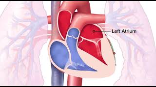 Mitral Valve Regurgitation [upl. by Atterys]