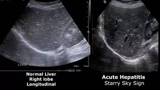 Liver Ultrasound Normal Vs Abnormal Image Appearances Comparison  Liver Ultrasound Pathologies [upl. by Fari]