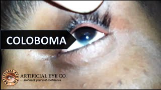 Coloboma Iris and Nystagmus  Anophthalmia  Dr Sumitra [upl. by Gipps671]