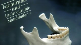 Mandibular Fractures  Favourable and Unfavourable [upl. by Lerraj]