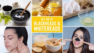 Easy Ways To Remove Blackheads And Whiteheads At Home [upl. by Peggi]