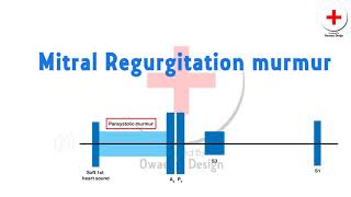 Mitral regurgitation murmur [upl. by Goodspeed]