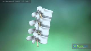 Spinal fractures Definition [upl. by Obocaj]