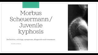 Morbus Scheuermann  Juvenile kyphosis Essential medicine [upl. by Nosmoht]