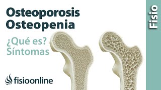 Osteoporosis y osteopenia  Qué es causas síntomas y tratamiento [upl. by Akirret]