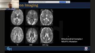 Radiological Diagnosis and Approach to Leukodystrophies [upl. by Betsey]