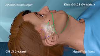 3D MACS e Neck Lift [upl. by Anialeh]