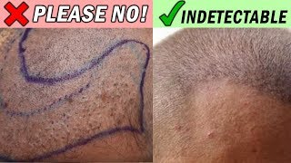 Transformative Hair Transplant Using Beard and Chest Hair  Anthony Bared MD FACS Miami FL [upl. by Bigler]