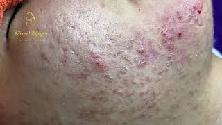 Blackheads Removal 333a  Loan Nguyen [upl. by Aldora121]