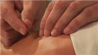 Acupuncture Treatments  Sciatica amp Acupuncture [upl. by Fablan624]